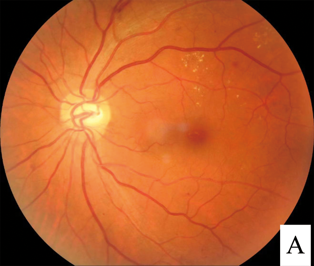 Fundus photograph showing retinal blood vessels and early signs of diabetic retinopathy
