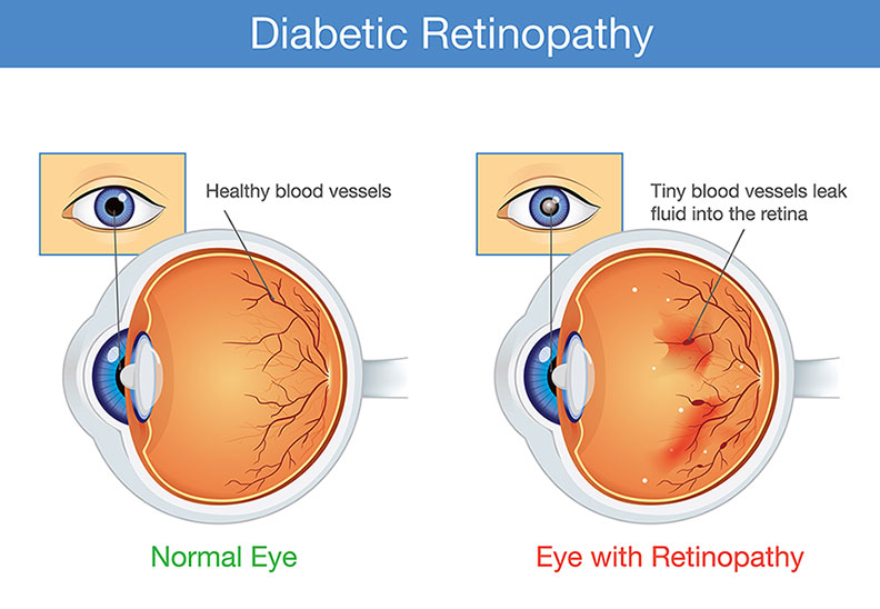 Comparison showing healthy blood vessels in a normal eye versus fluid leaking from damaged blood vessels in the retina of an eye with diabetic retinopathy